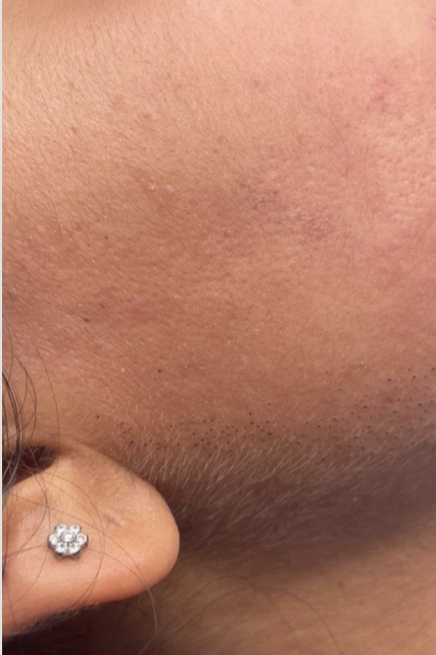 Electrolysis, after treatment at Nimor Aesthetic