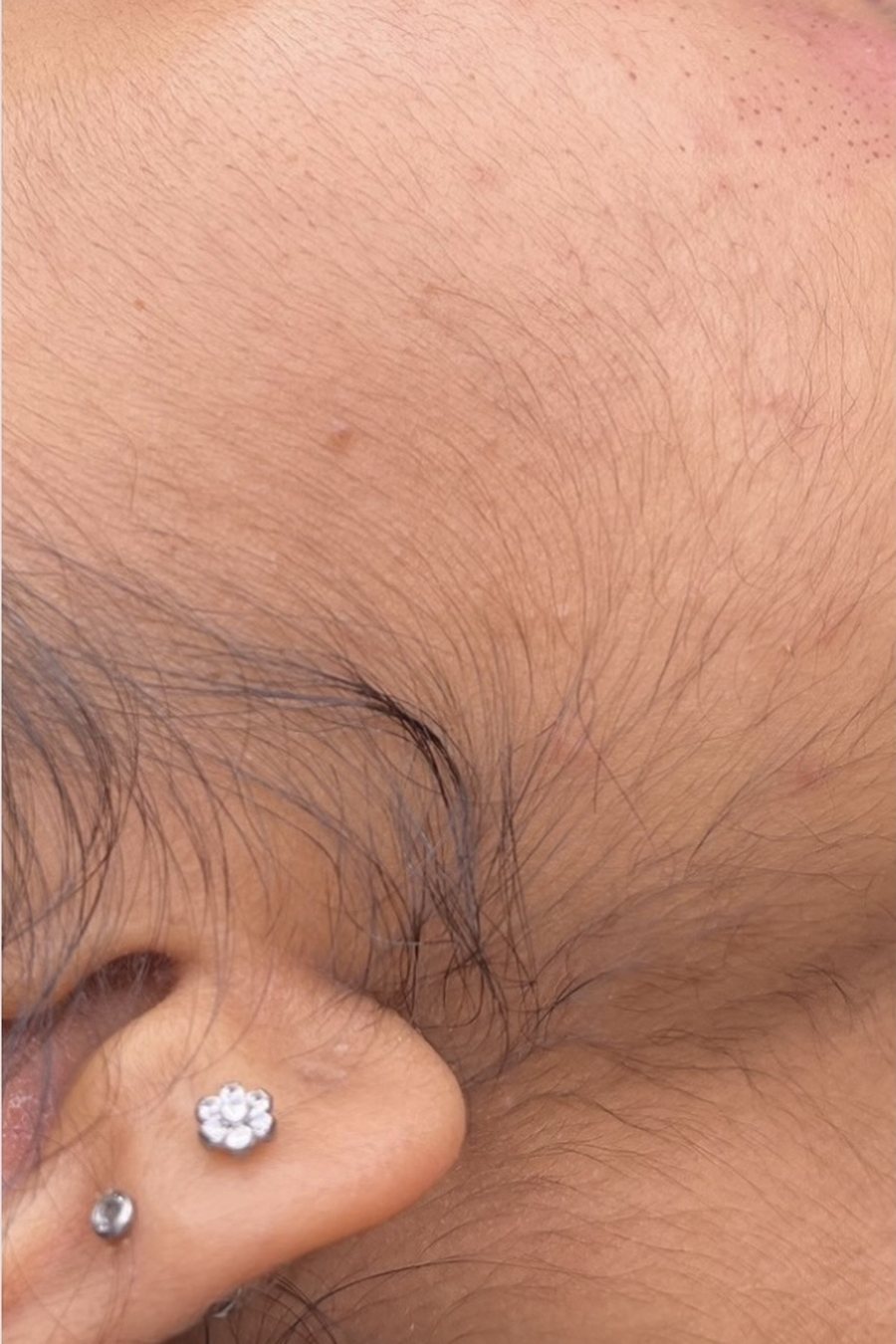 Electrolysis, before treatment