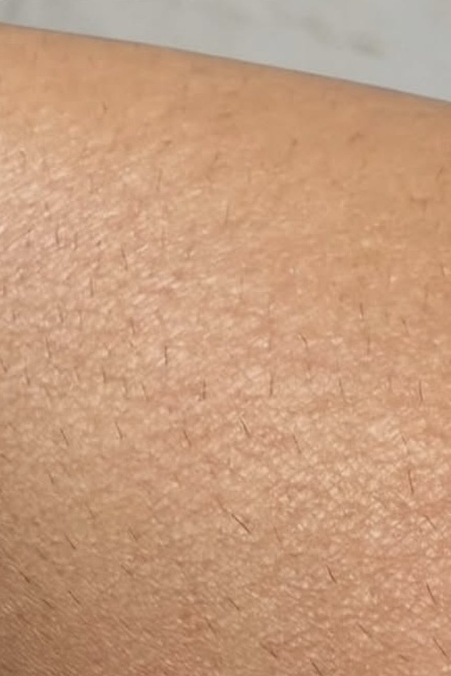 Laser hair removal, after treatment at Nimor Aesthetic