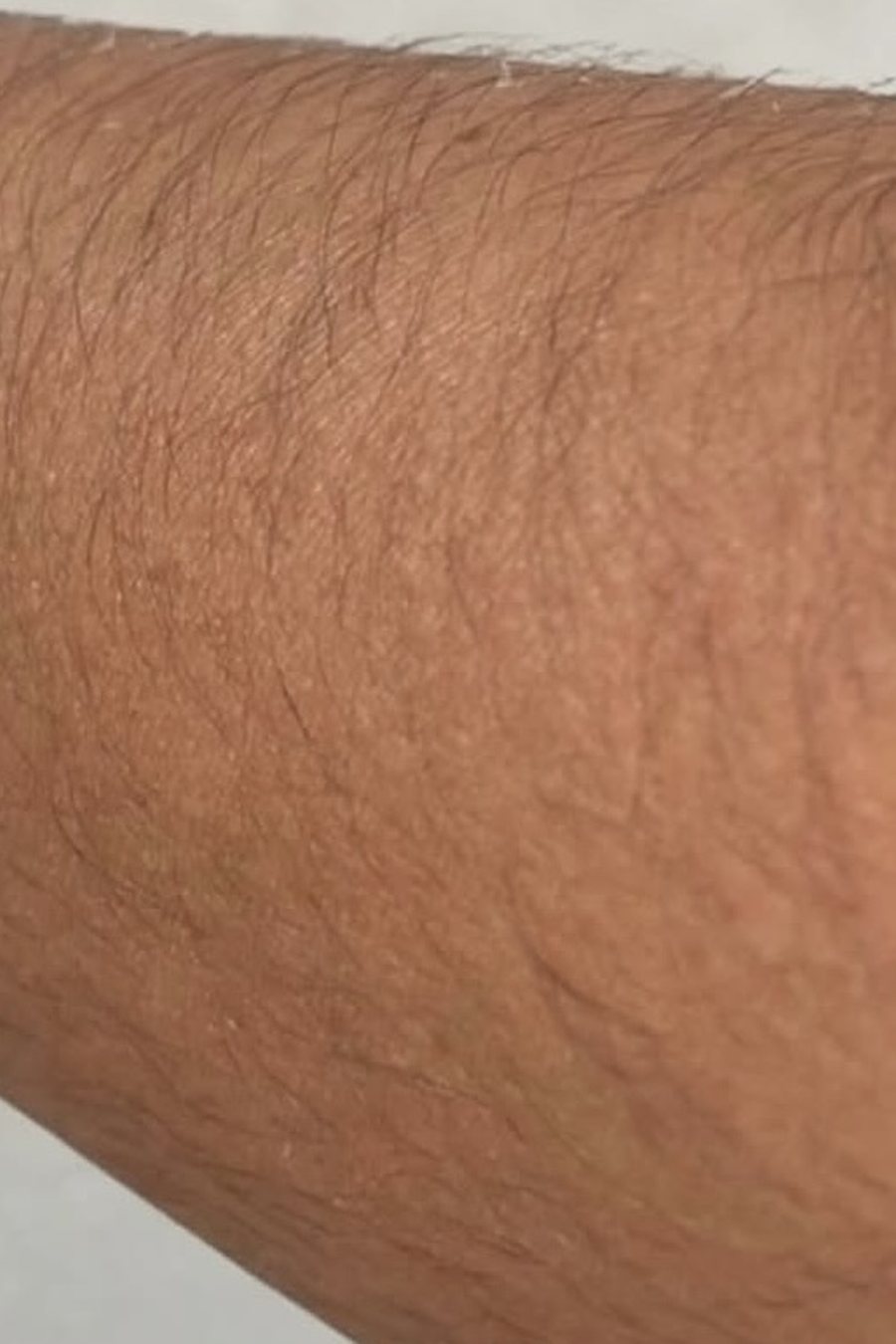 Laser hair removal, before treatment